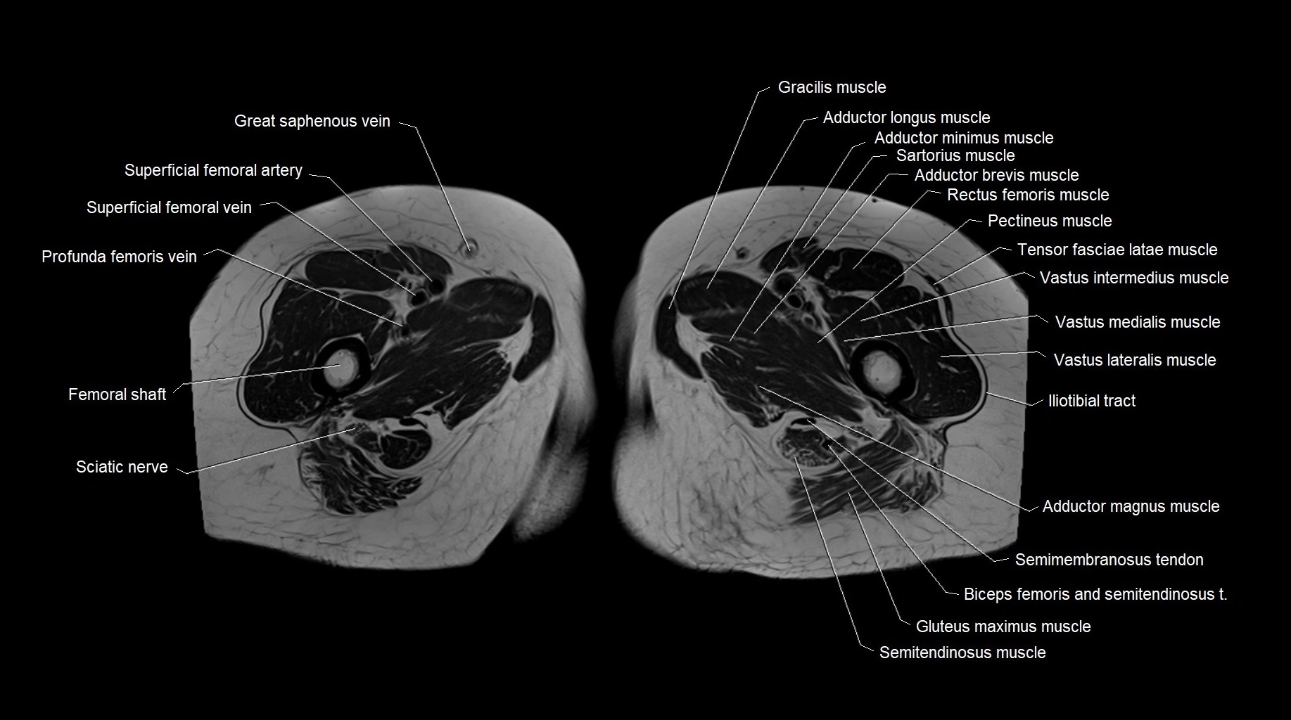 MRI 3T pelvis axial cross section anatomy image 38.webp